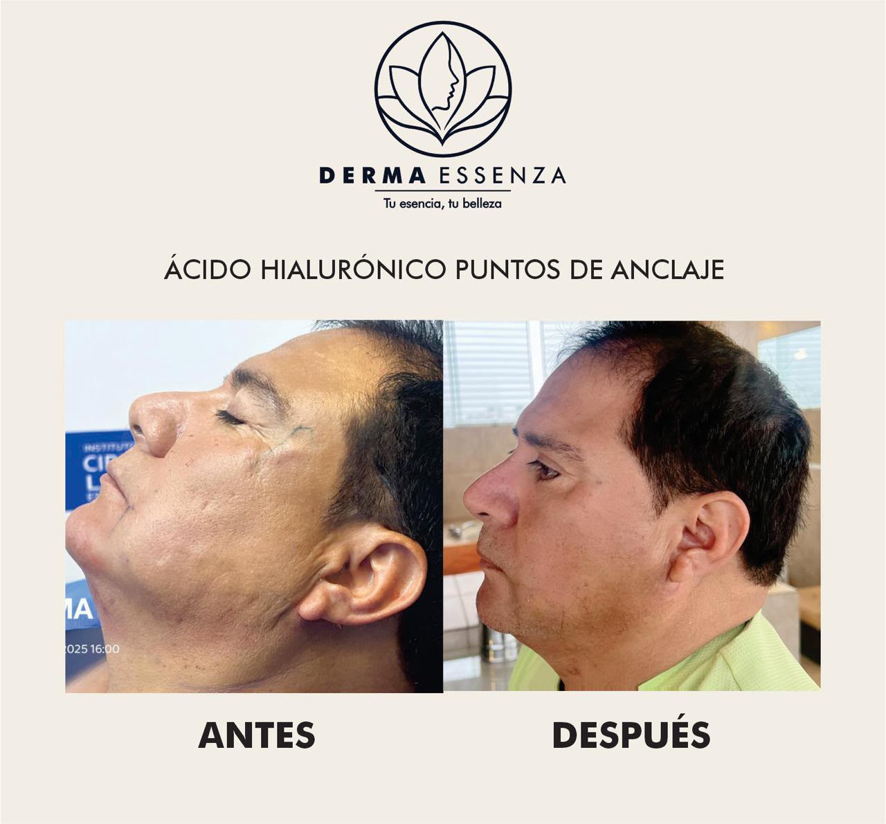 Ácido hialurónico