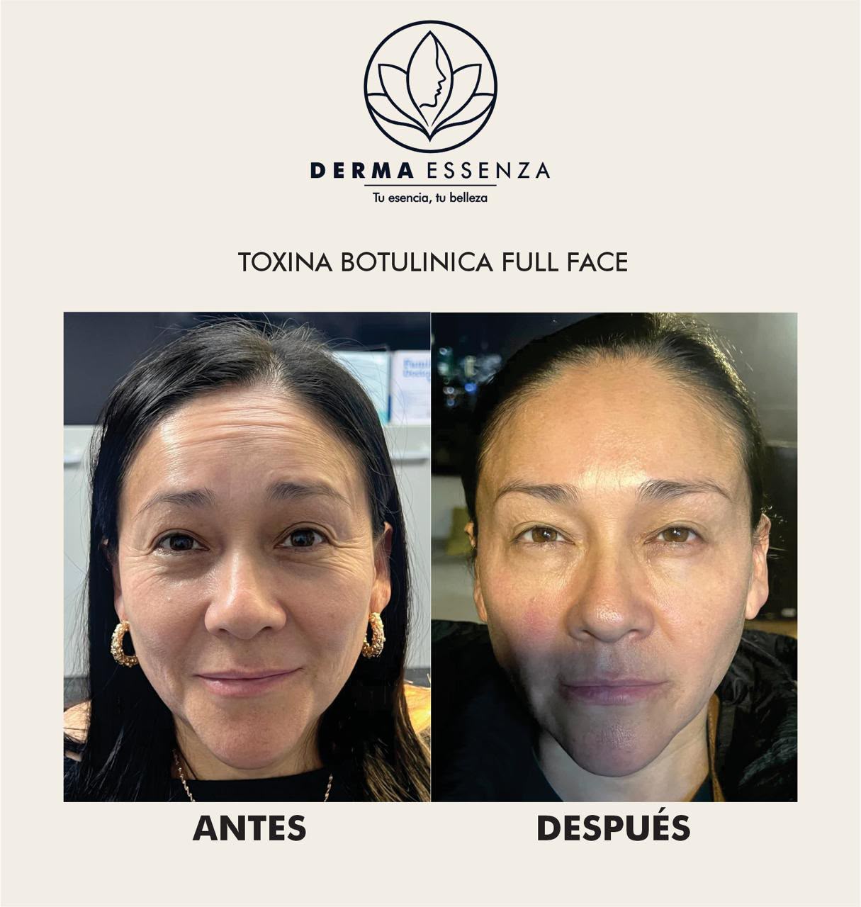 Plasma rico en plaquetas (PRP)